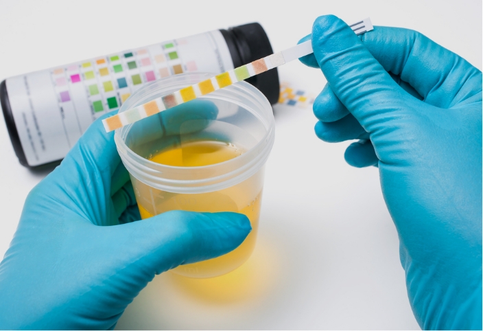 Urine Analysis